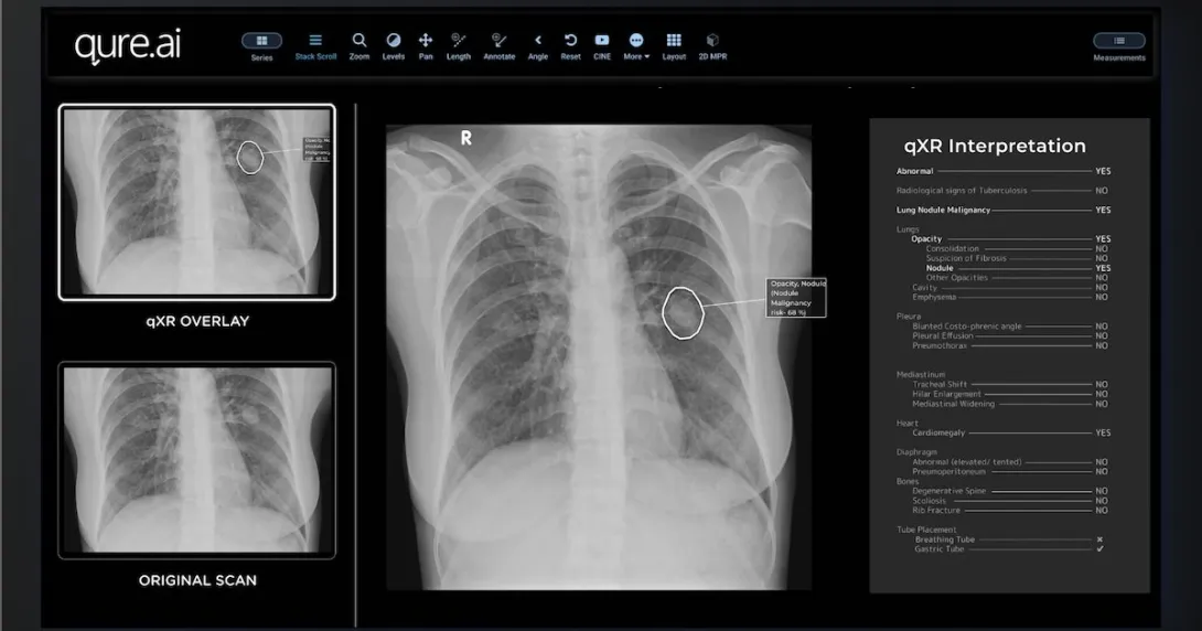 
  Qure.ai's qXR software for the detection of abnormalities in chest x-rays
