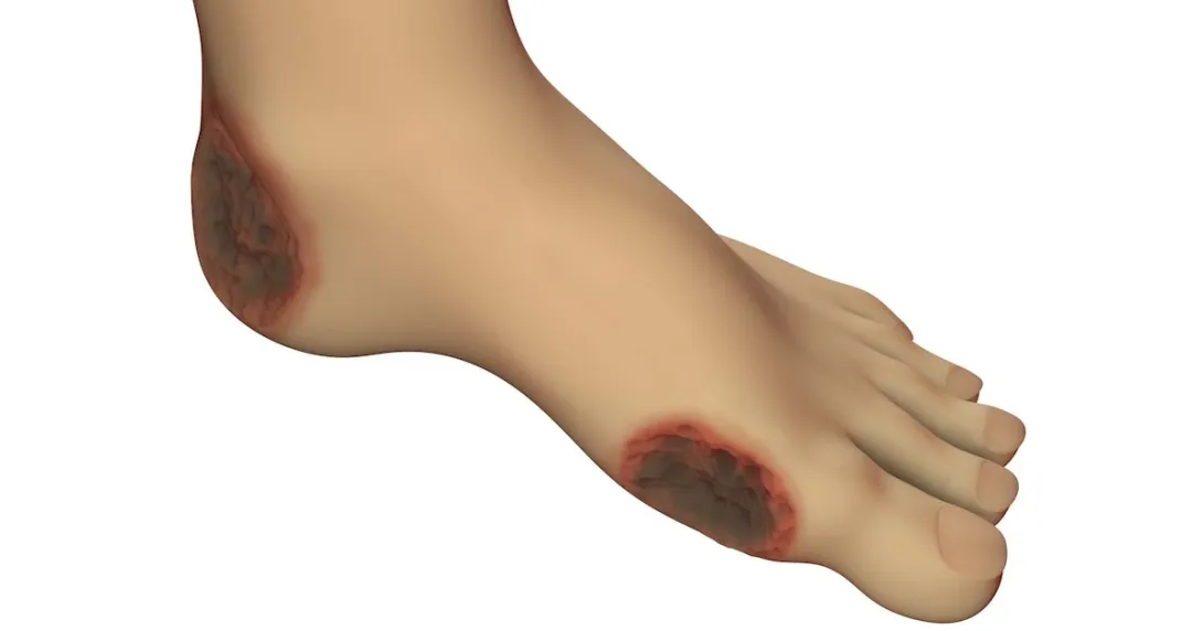 Image of a foot wound Image of a foot wound
